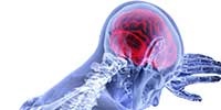 Concussion and Mild Traumatic Brain Injury: The Musculoskeletal and Neurometabolic Cascade of Impact Not Found